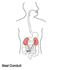 illeal-conduit-urostomy-ostomy-illustration