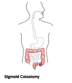 sigmoid-colostomy-ostomy-illustration